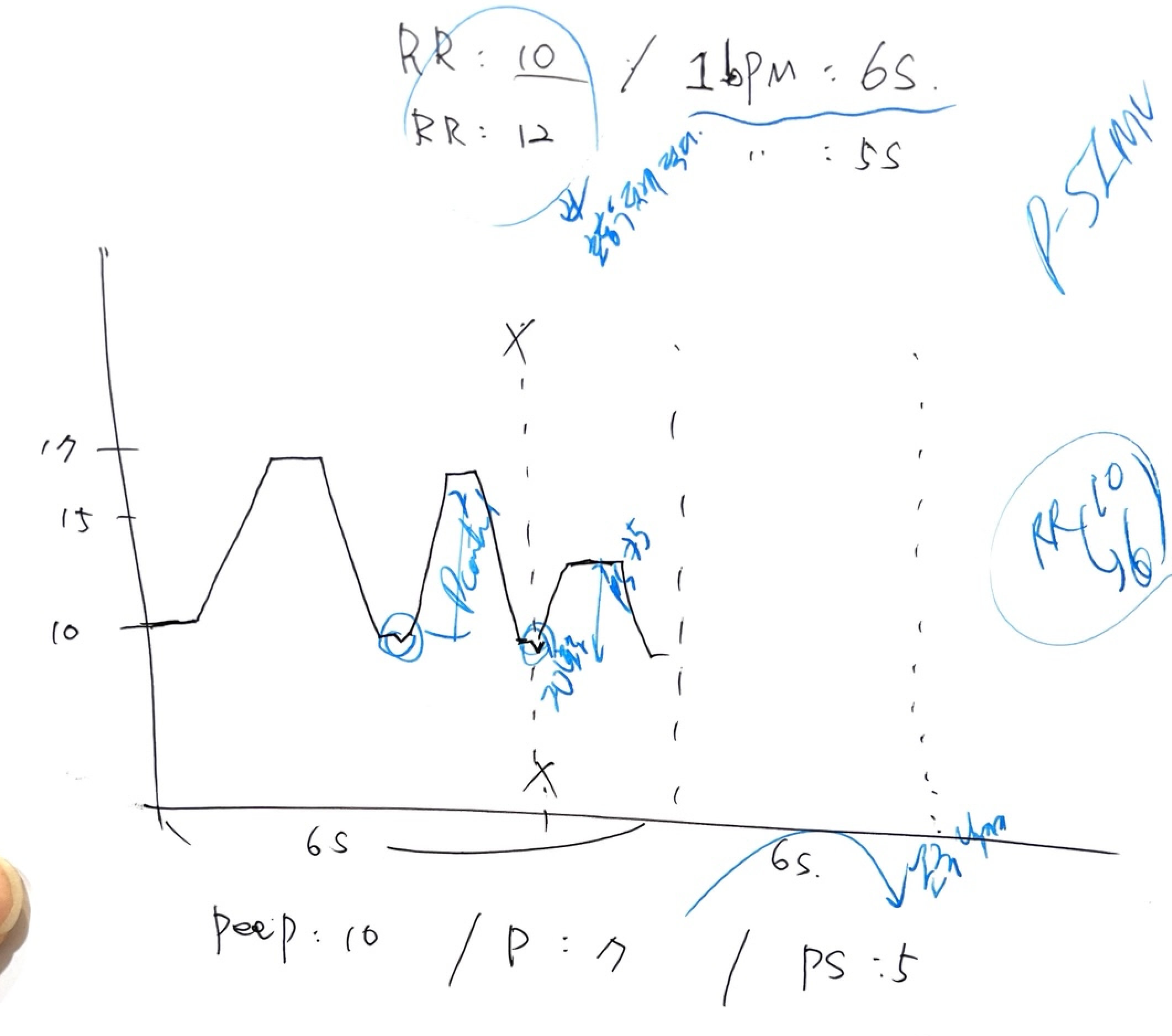 SIMV pressure waveform schematic