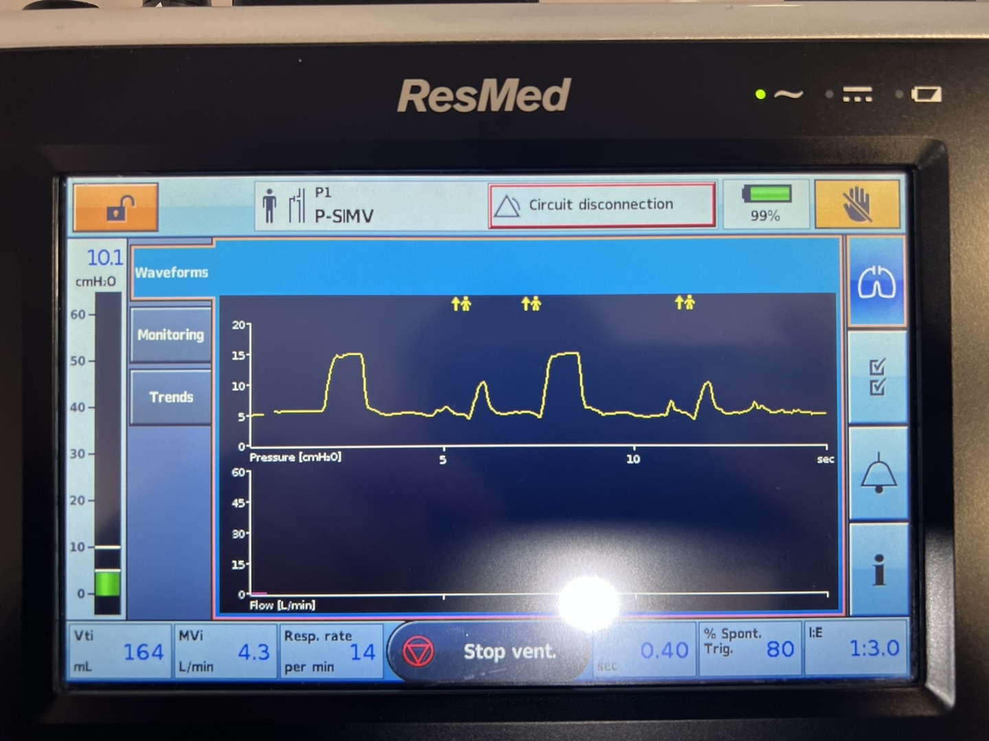 Waveforms showing one mandatory breath and several spontaneous breaths