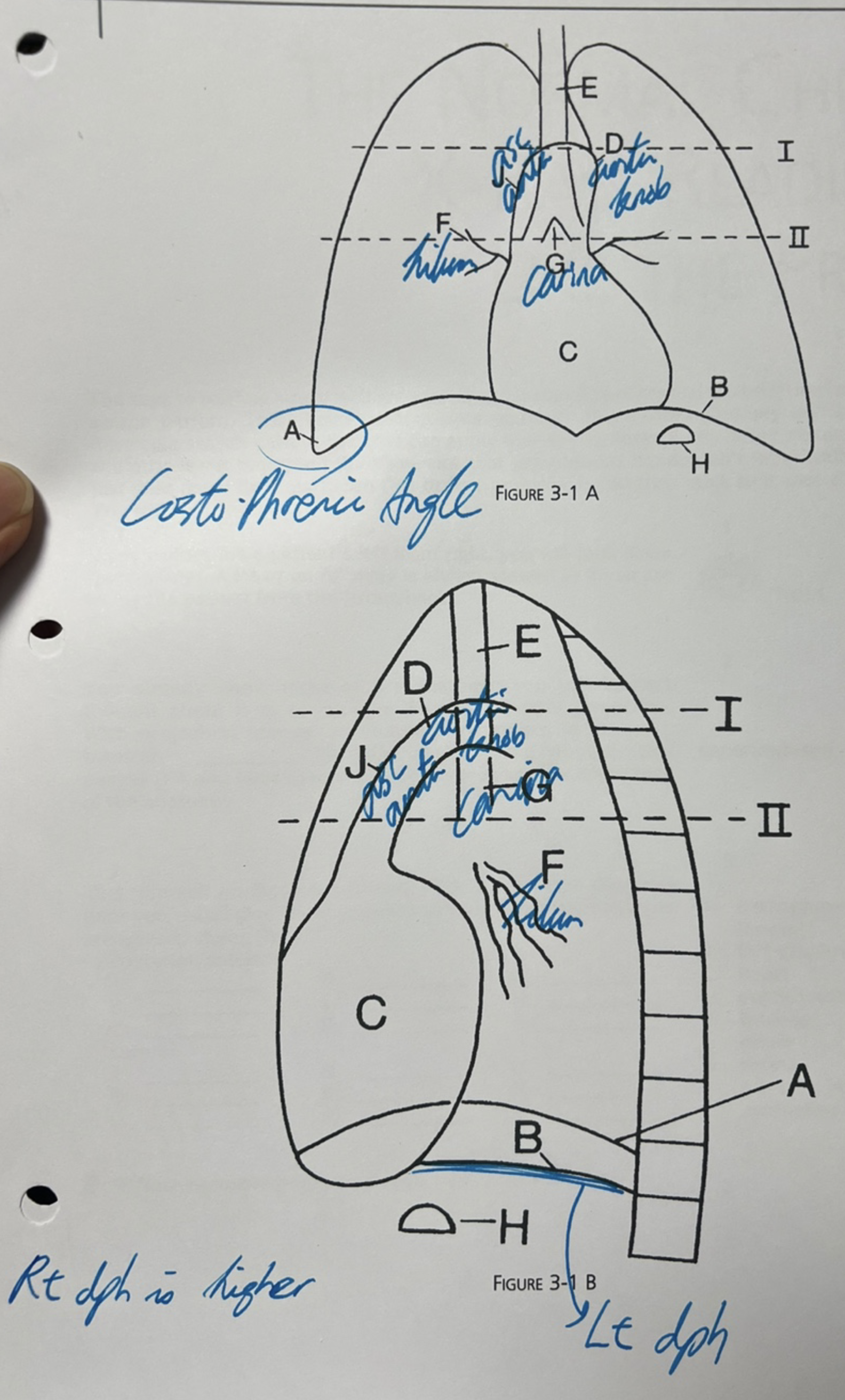 Normal chest X-ray anatomy diagram