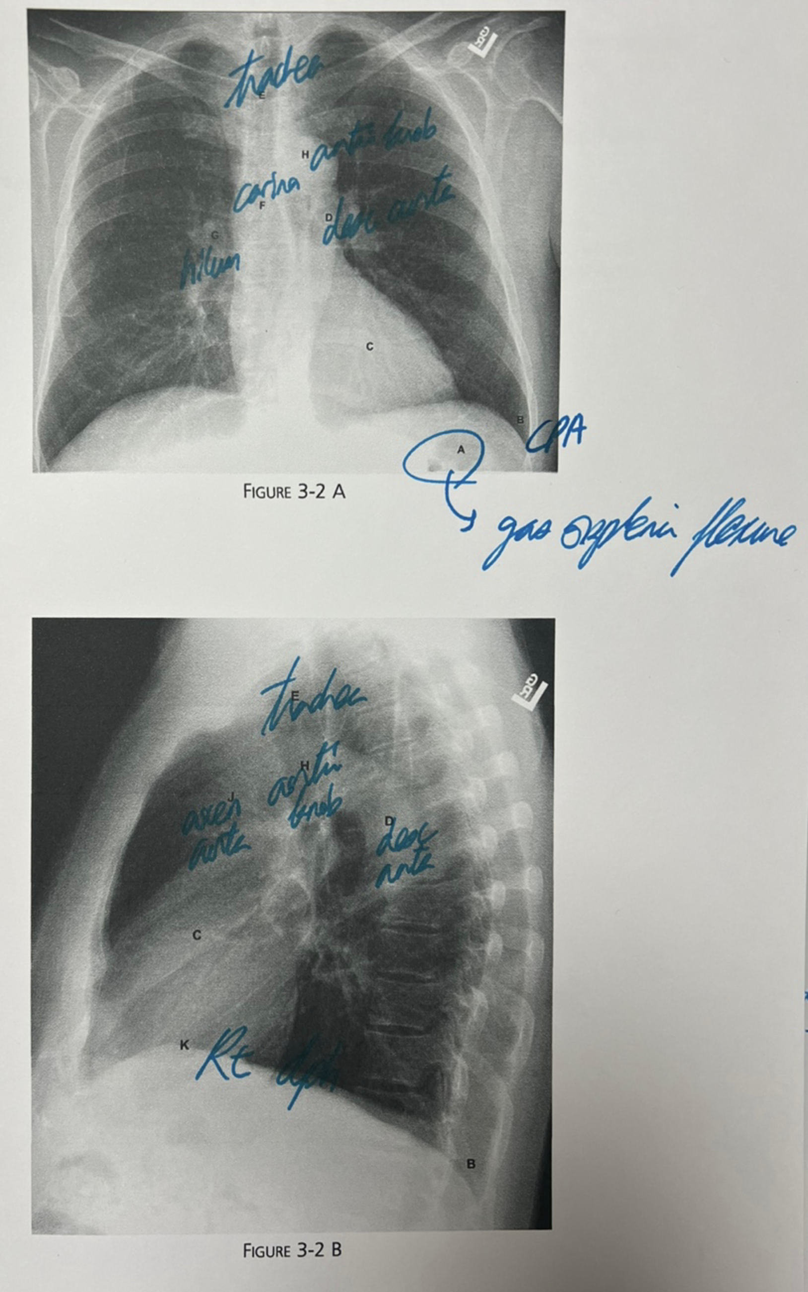 Real chest radiograph with labels