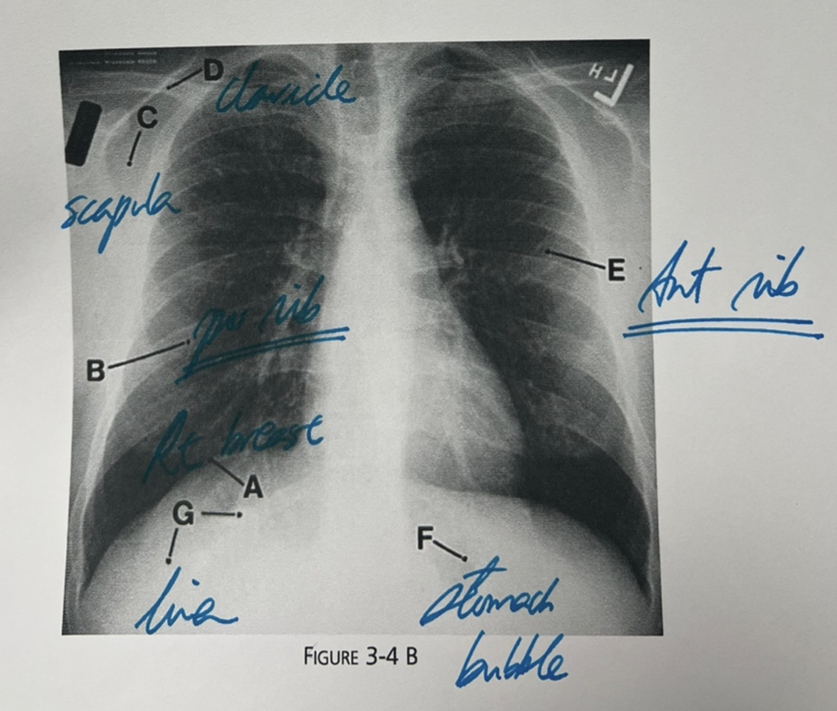 Another chest X-ray radiograph with labels