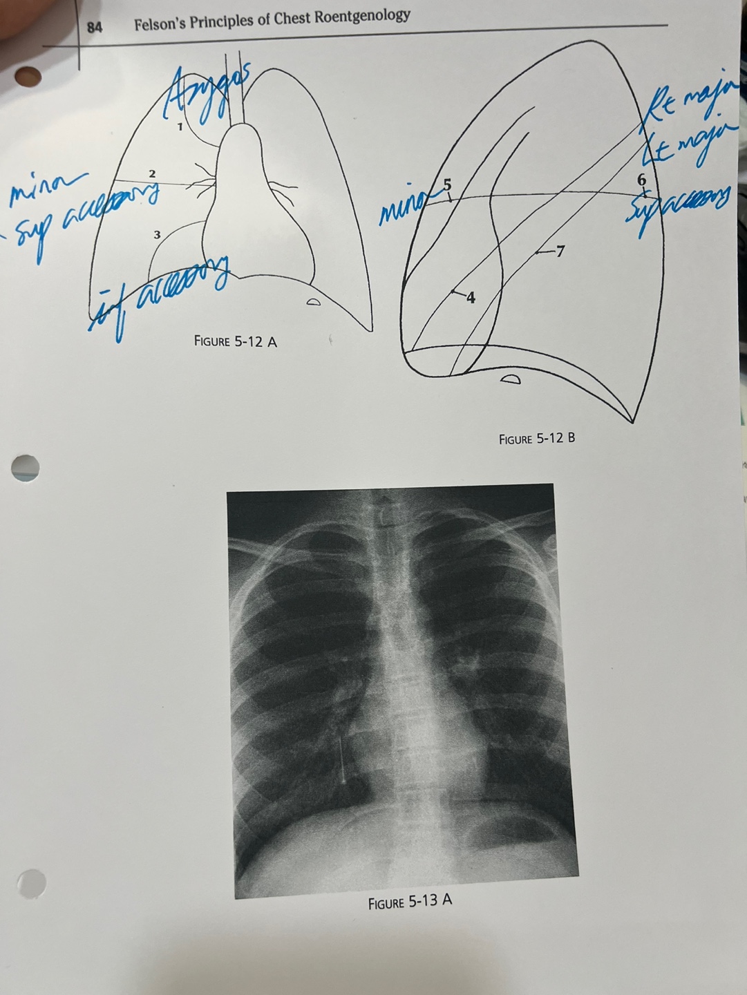 Accessory fissures - Azygos