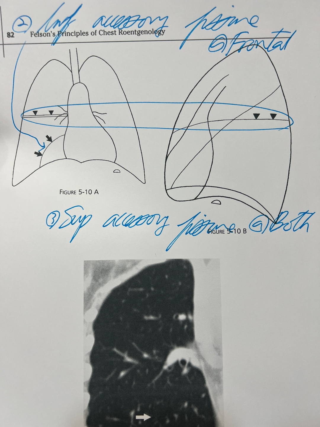 Accessory fissures - Additional details