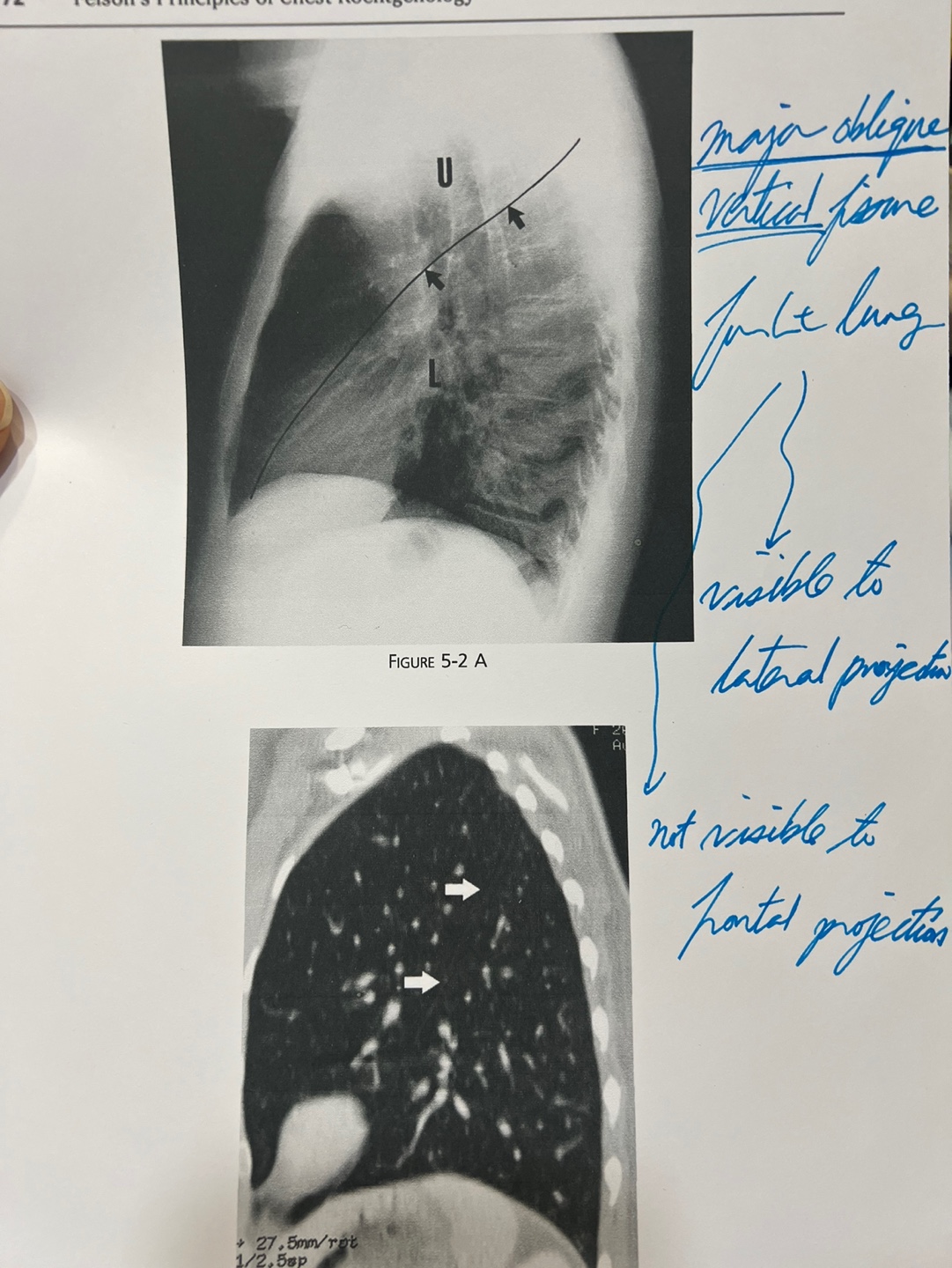 Major oblique vertical fissure in the left lung